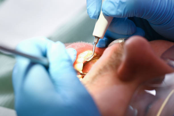 Best Dental Abscess Treatment in Downey, CA
